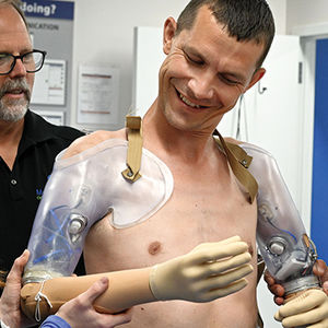 person using a prosthetics arm